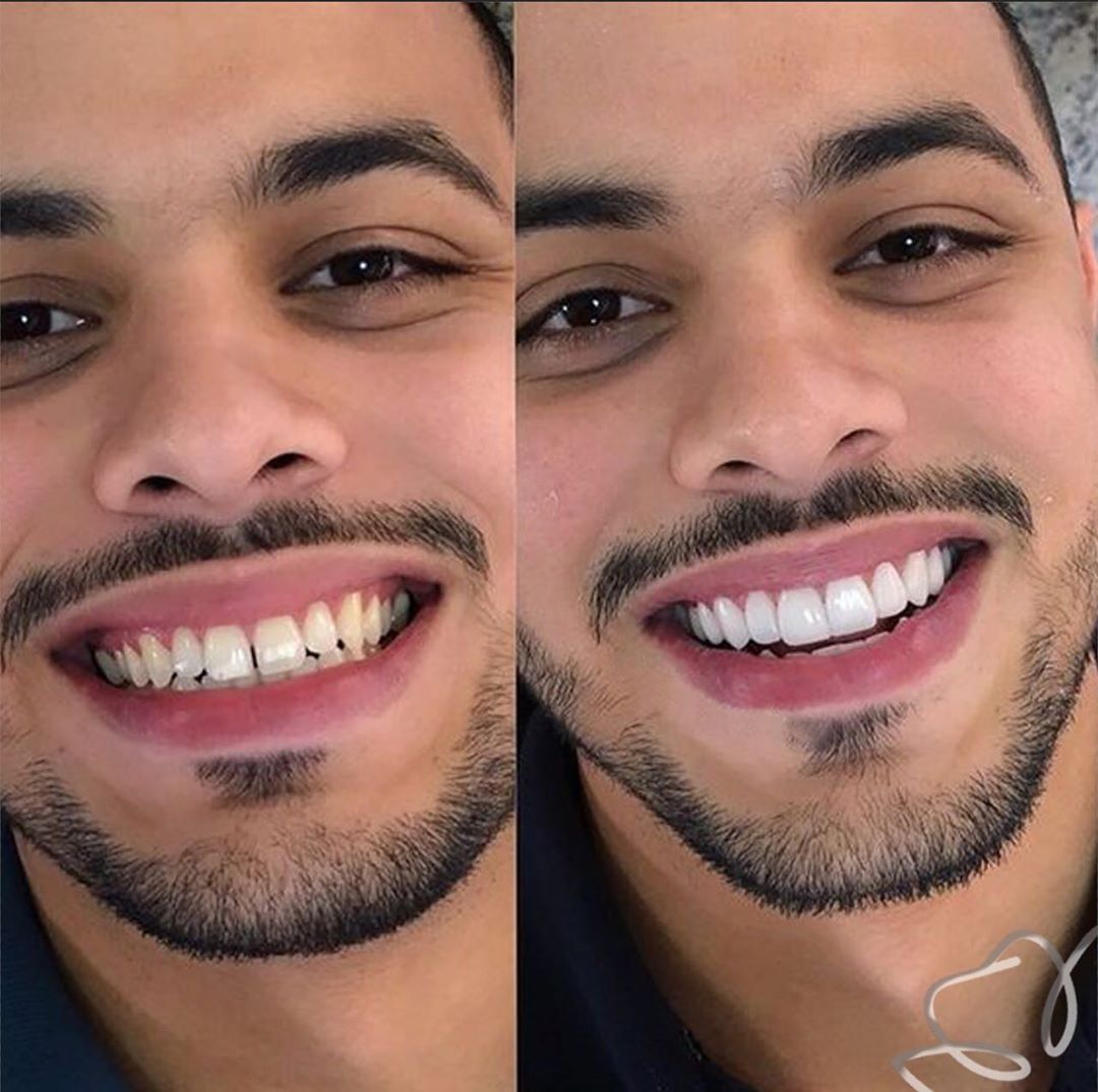 😁 CARILLAS DENTALES | SONRIE CON CONFIANZA Y ESTILO